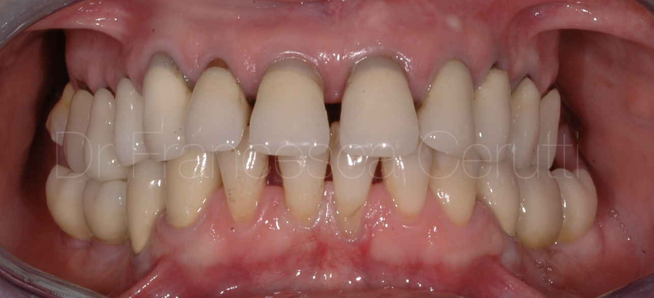 Pre prosthetic ortho - Ortodonzia pre protesica