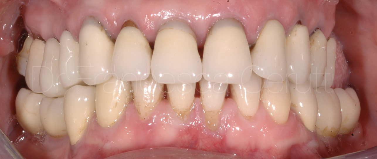 Pre prosthetic ortho - Ortodonzia pre protesica